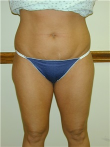Liposuction Before Photo by Randy Proffitt, MD; Mobile, AL - Case 21855
