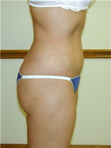 Liposuction After Photo by Randy Proffitt, MD; Mobile, AL - Case 21855