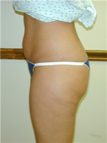 Liposuction Before Photo by Randy Proffitt, MD; Mobile, AL - Case 21855