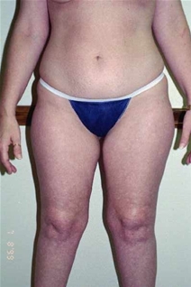 Liposuction Before Photo by Randy Proffitt, MD; Mobile, AL - Case 21857