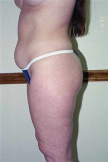 Liposuction Before Photo by Randy Proffitt, MD; Mobile, AL - Case 21857
