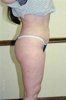 Liposuction After Photo by Randy Proffitt, MD; Mobile, AL - Case 21857