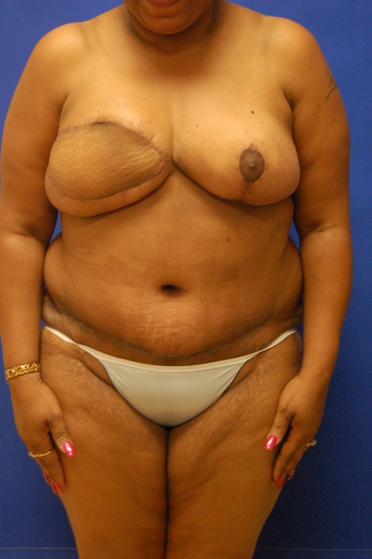 Breast Reduction Before and After Photos by Randy Proffitt, MD; Mobile, AL  - Case 21858
