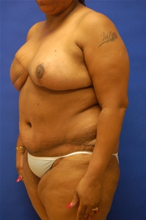 Breast Reduction After Photo by Randy Proffitt, MD; Mobile, AL - Case 21858