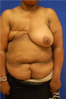 Breast Reconstruction Before Photo by Randy Proffitt, MD; Mobile, AL - Case 21859