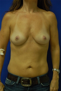 Breast Augmentation Before Photo by Randy Proffitt, MD; Mobile, AL - Case 21956