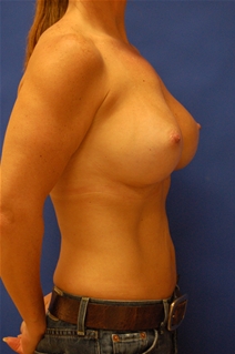 Breast Augmentation After Photo by Randy Proffitt, MD; Mobile, AL - Case 21956