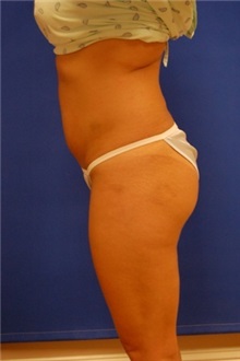 Liposuction Before Photo by Randy Proffitt, MD; Mobile, AL - Case 22000