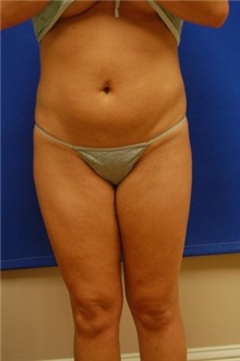 Liposuction After Photo by Randy Proffitt, MD; Mobile, AL - Case 22000