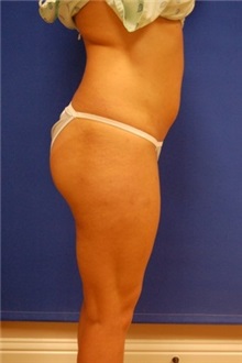 Liposuction Before Photo by Randy Proffitt, MD; Mobile, AL - Case 22000