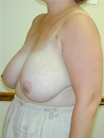 Breast Reduction Before Photo by Randy Proffitt, MD; Mobile, AL - Case 22004