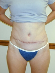 Tummy Tuck After Photo by Randy Proffitt, MD; Mobile, AL - Case 22006