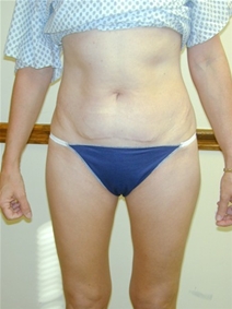 Tummy Tuck Before Photo by Randy Proffitt, MD; Mobile, AL - Case 22006