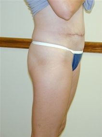 Tummy Tuck After Photo by Randy Proffitt, MD; Mobile, AL - Case 22006