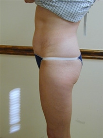 Tummy Tuck Before Photo by Randy Proffitt, MD; Mobile, AL - Case 22006