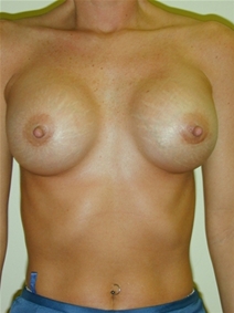 Breast Augmentation After Photo by Randy Proffitt, MD; Mobile, AL - Case 22007