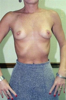 Breast Augmentation Before Photo by Randy Proffitt, MD; Mobile, AL - Case 22007