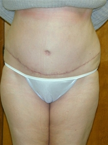 Tummy Tuck After Photo by Randy Proffitt, MD; Mobile, AL - Case 22011