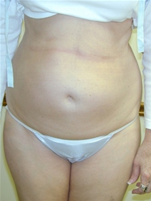 Tummy Tuck Before Photo by Randy Proffitt, MD; Mobile, AL - Case 22011