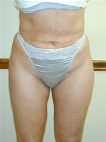 Liposuction After Photo by Randy Proffitt, MD; Mobile, AL - Case 22012
