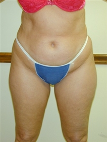 Liposuction Before Photo by Randy Proffitt, MD; Mobile, AL - Case 22012