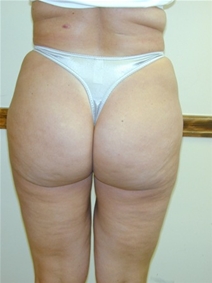 Liposuction After Photo by Randy Proffitt, MD; Mobile, AL - Case 22012