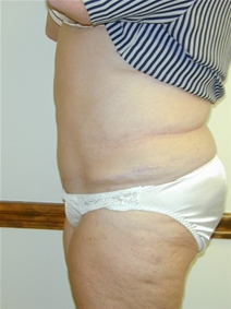 Liposuction After Photo by Randy Proffitt, MD; Mobile, AL - Case 22013
