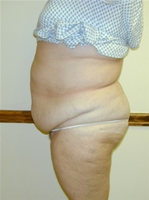 Liposuction Before Photo by Randy Proffitt, MD; Mobile, AL - Case 22013