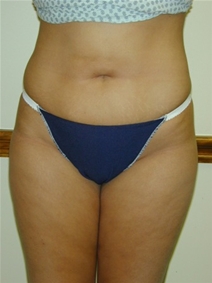 Liposuction After Photo by Randy Proffitt, MD; Mobile, AL - Case 22018