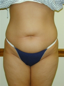 Liposuction Before Photo by Randy Proffitt, MD; Mobile, AL - Case 22018