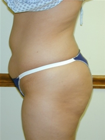 Liposuction Before Photo by Randy Proffitt, MD; Mobile, AL - Case 22018