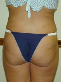 Liposuction After Photo by Randy Proffitt, MD; Mobile, AL - Case 22018
