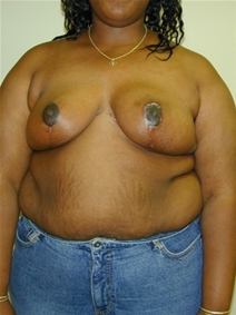 Breast Reduction After Photo by Randy Proffitt, MD; Mobile, AL - Case 22023