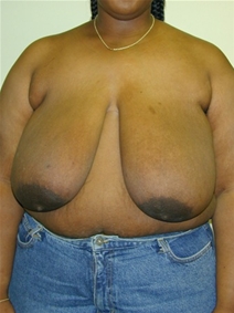 Breast Reduction Before Photo by Randy Proffitt, MD; Mobile, AL - Case 22023