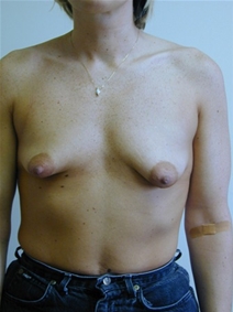 Breast Augmentation Before Photo by Randy Proffitt, MD; Mobile, AL - Case 22024