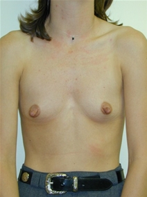Breast Augmentation Before Photo by Randy Proffitt, MD; Mobile, AL - Case 22025