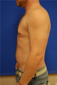 Male Breast Reduction After Photo by Randy Proffitt, MD; Mobile, AL - Case 22094