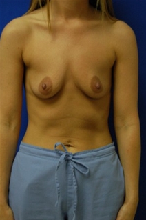 Breast Augmentation Before Photo by Randy Proffitt, MD; Mobile, AL - Case 22196