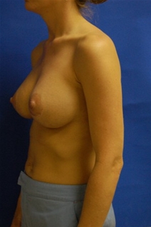 Breast Augmentation After Photo by Randy Proffitt, MD; Mobile, AL - Case 22196