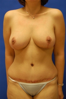 Tummy Tuck After Photo by Randy Proffitt, MD; Mobile, AL - Case 22338
