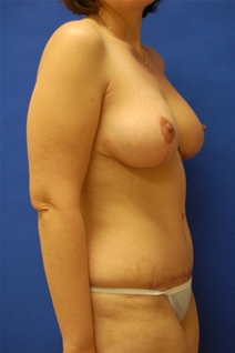 Tummy Tuck After Photo by Randy Proffitt, MD; Mobile, AL - Case 22338