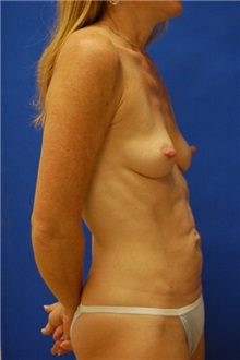 Breast Augmentation Before Photo by Randy Proffitt, MD; Mobile, AL - Case 22388