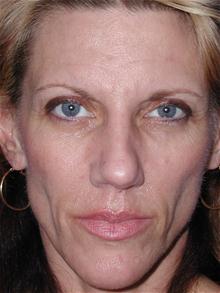 Facelift Before Photo by Jonathan Berman, MD, FACS; Boca Raton, FL - Case 27617