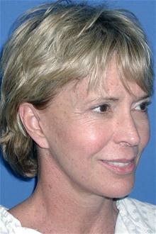 Facelift After Photo by Jonathan Berman, MD, FACS; Boca Raton, FL - Case 27618