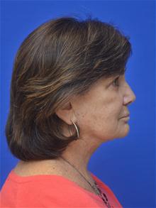 Facelift After Photo by Jonathan Berman, MD, FACS; Boca Raton, FL - Case 27619