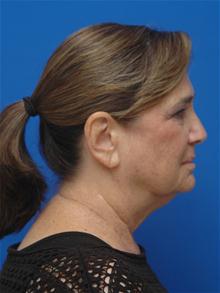 Facelift Before Photo by Jonathan Berman, MD, FACS; Boca Raton, FL - Case 27619