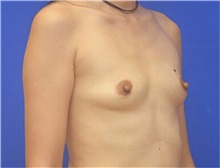 Breast Augmentation Before Photo by Jonathan Berman, MD, FACS; Boca Raton, FL - Case 37597