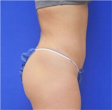 Liposuction After Photo by Jonathan Berman, MD, FACS; Boca Raton, FL - Case 37599