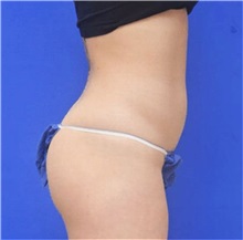 Liposuction Before Photo by Jonathan Berman, MD, FACS; Boca Raton, FL - Case 37599