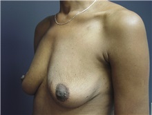 Breast Augmentation Before Photo by Emily Pollard, MD; Ardmore, PA - Case 24239
